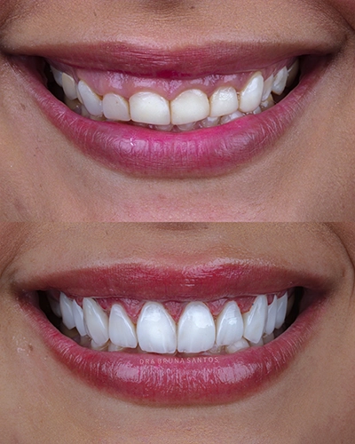 Antes-e-depois2.webp