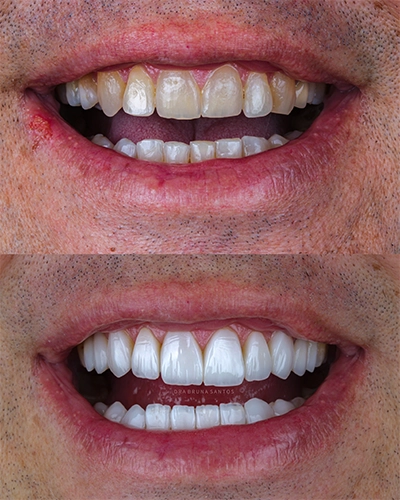 Antes-e-depois3.webp